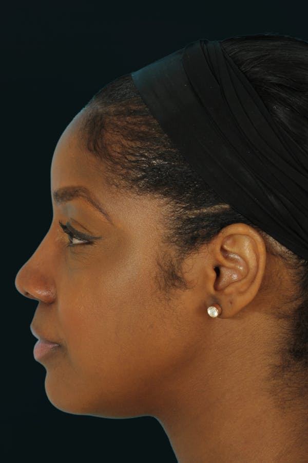Before & Afters Before & After Gallery - Patient 251864 - Image 2