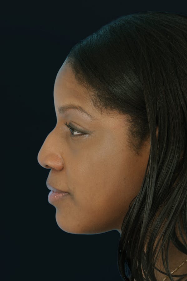 Before & Afters Before & After Gallery - Patient 251864 - Image 1