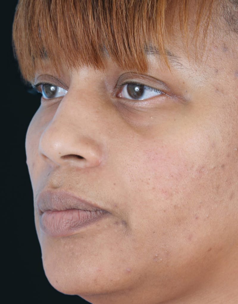 Before & Afters Before & After Gallery - Patient 319737 - Image 3