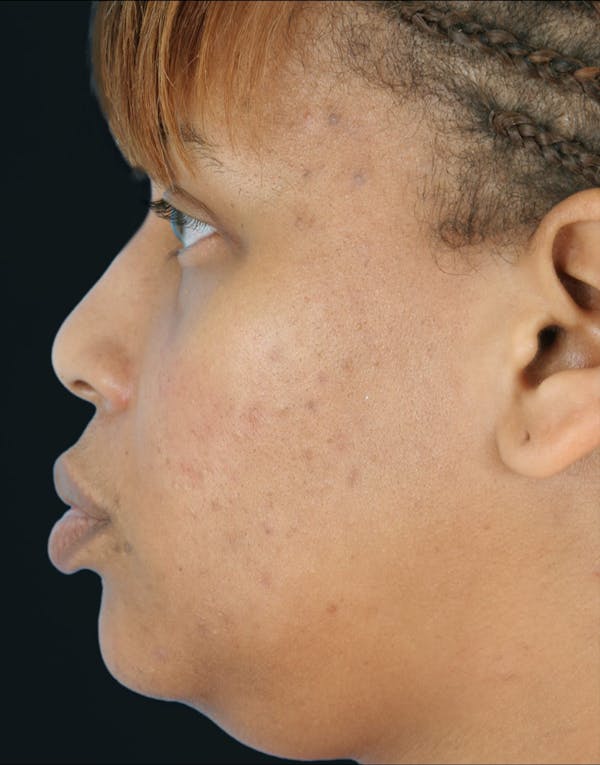 Before & Afters Before & After Gallery - Patient 319737 - Image 1