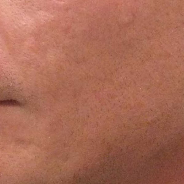 Before & Afters Before & After Gallery - Patient 283323 - Image 2