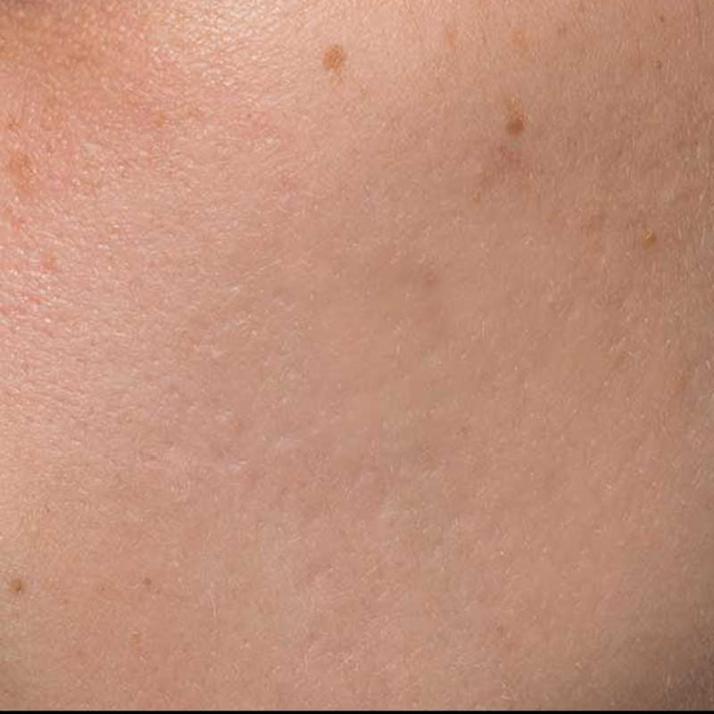 Before & Afters Before & After Gallery - Patient 398088 - Image 2