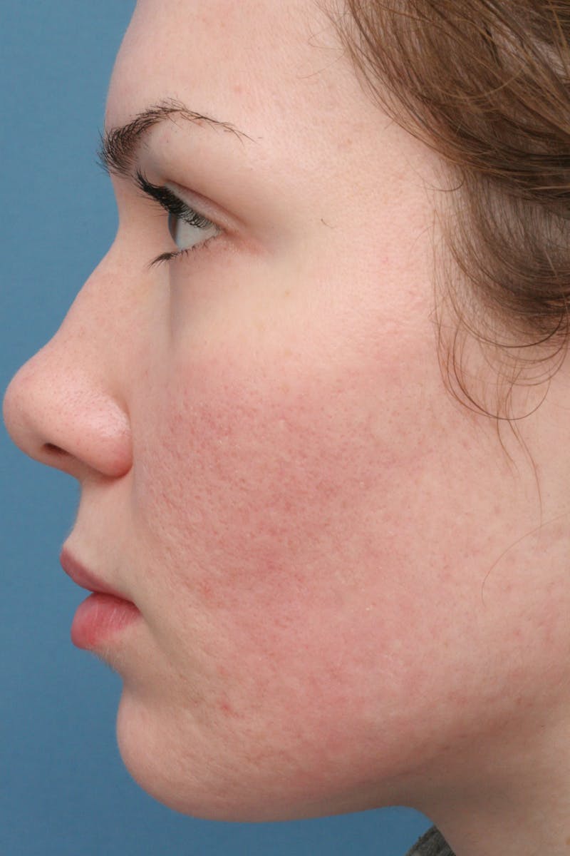 Before & Afters Before & After Gallery - Patient 226993 - Image 2