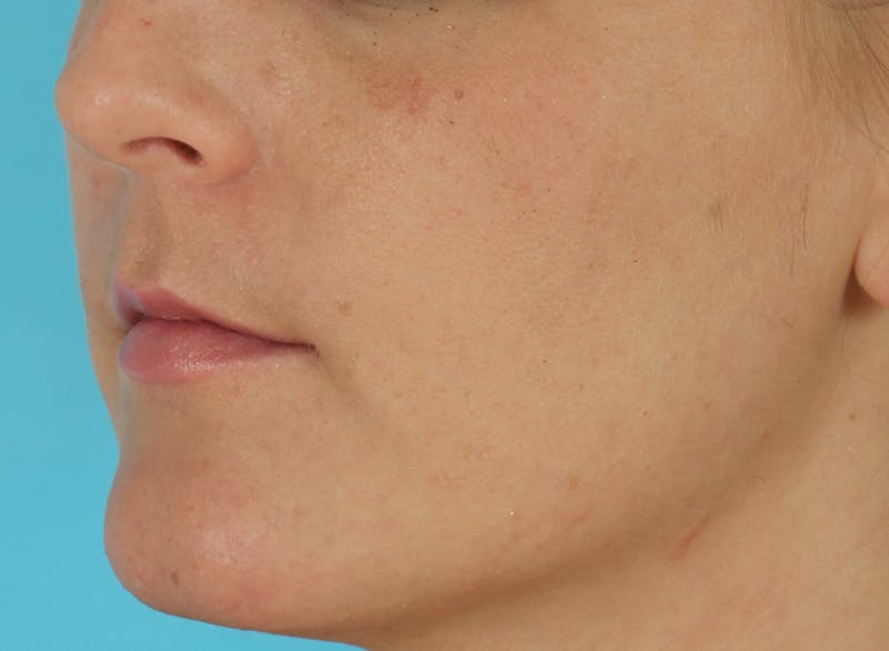Before & Afters Before & After Gallery - Patient 311961 - Image 2