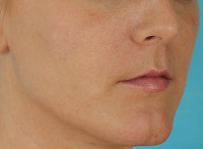 Before & Afters Before & After Gallery - Patient 360588 - Image 2