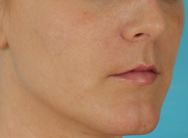 Before & Afters Before & After Gallery - Patient 360588 - Image 2