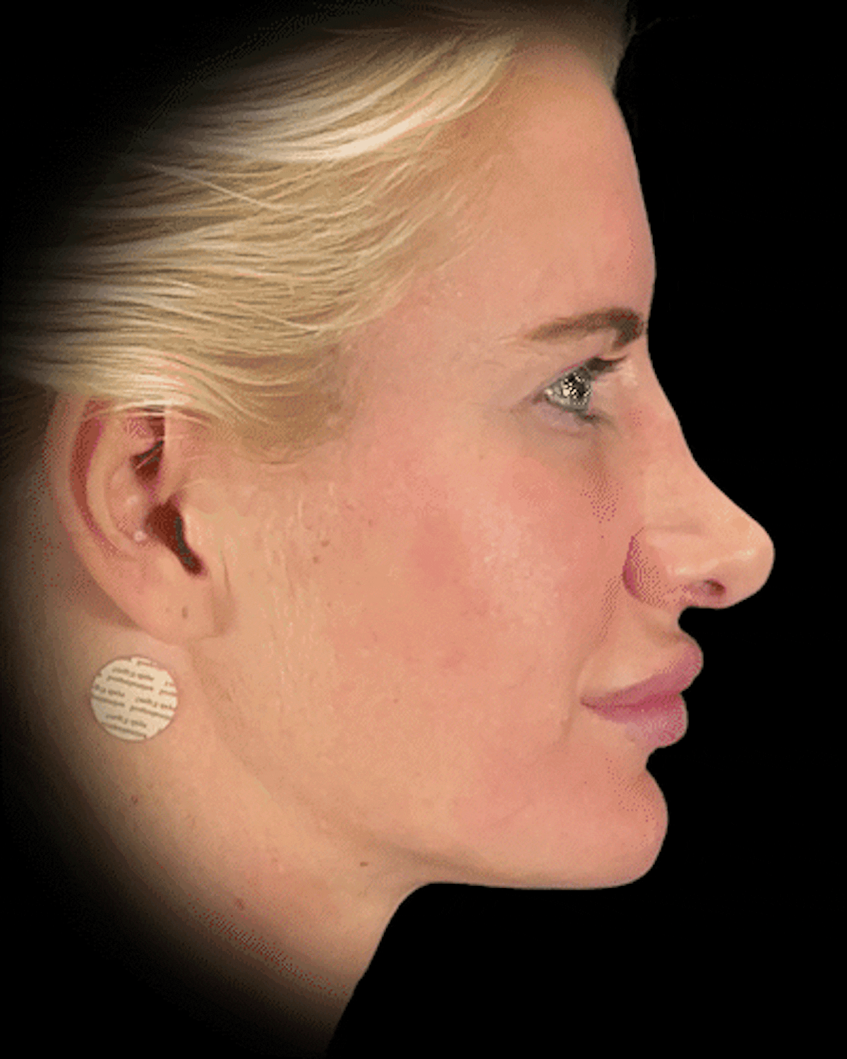 Gifs Before & After Gallery - Patient 399926 - Image 1