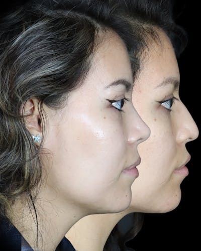 Before & Afters Before & After Gallery - Patient 208421 - Image 1