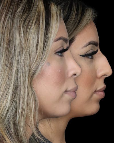 Before & Afters Before & After Gallery - Patient 210992 - Image 1