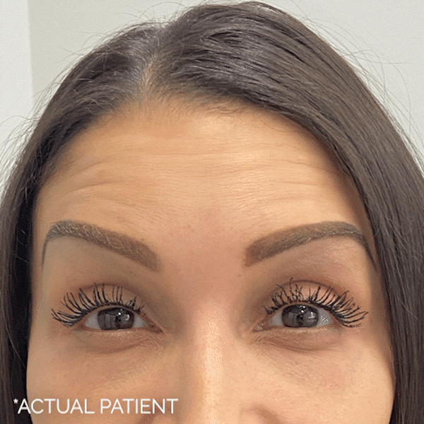 GIFs Before & After Gallery - Patient 323914 - Image 1