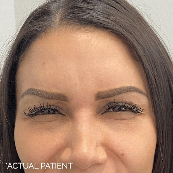 GIFs Before & After Gallery - Patient 217694 - Image 1