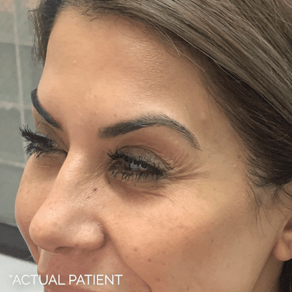 GIFs Before & After Gallery - Patient 413596 - Image 1