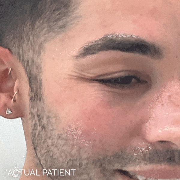 GIFs Before & After Gallery - Patient 329725 - Image 1
