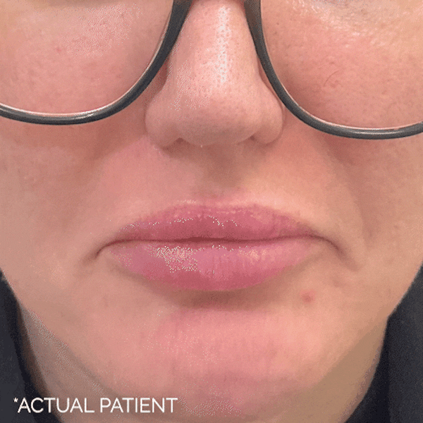 GIFs Before & After Gallery - Patient 141590 - Image 1