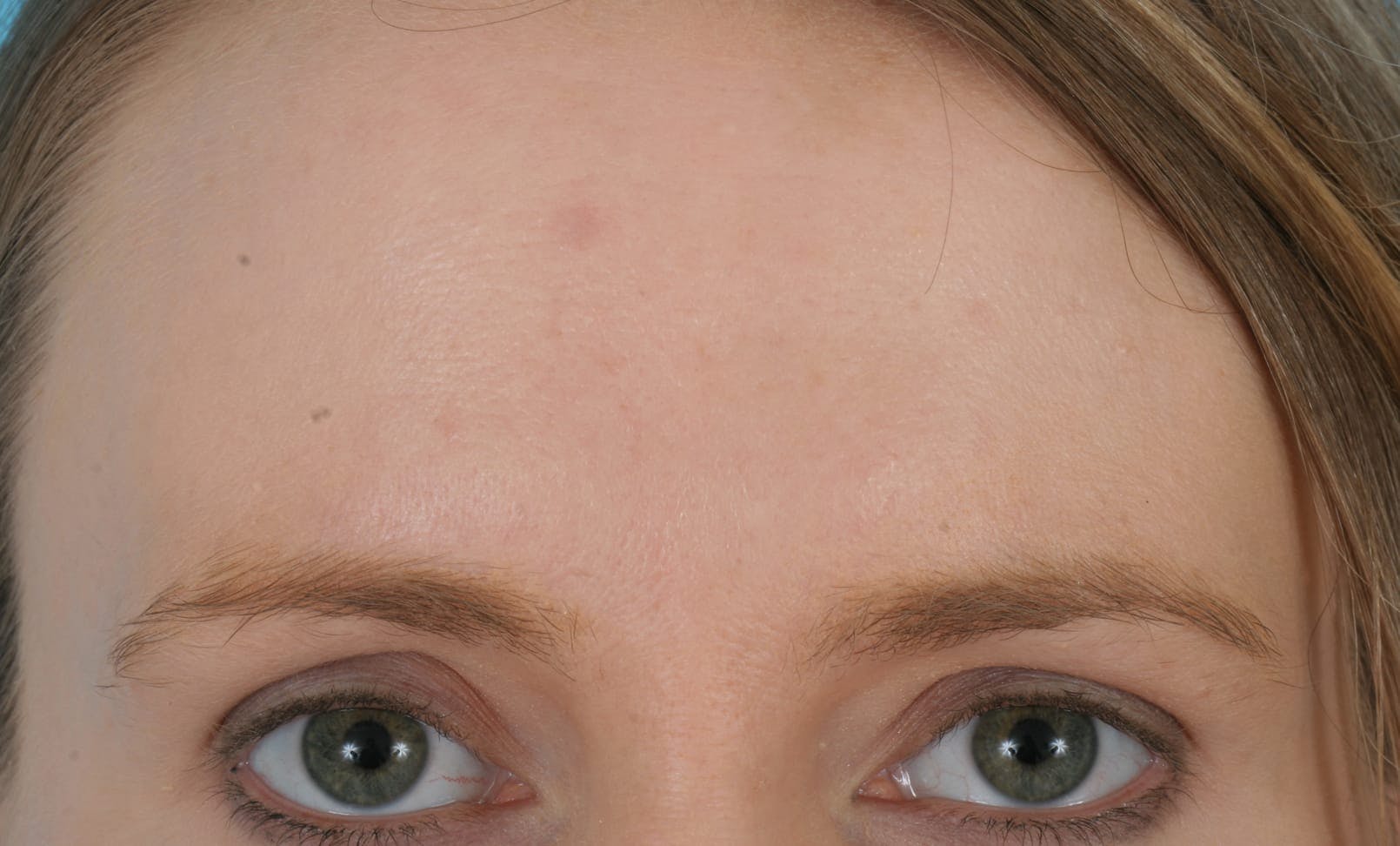 Before & Afters Before & After Gallery - Patient 375333 - Image 1