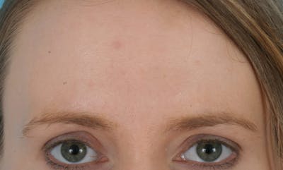 Before & Afters Before & After Gallery - Patient 375333 - Image 1