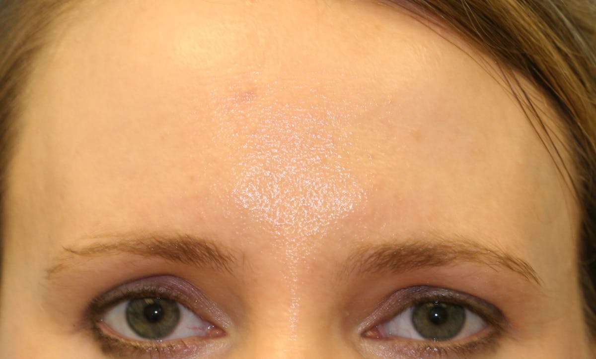 Before & Afters Before & After Gallery - Patient 375333 - Image 2