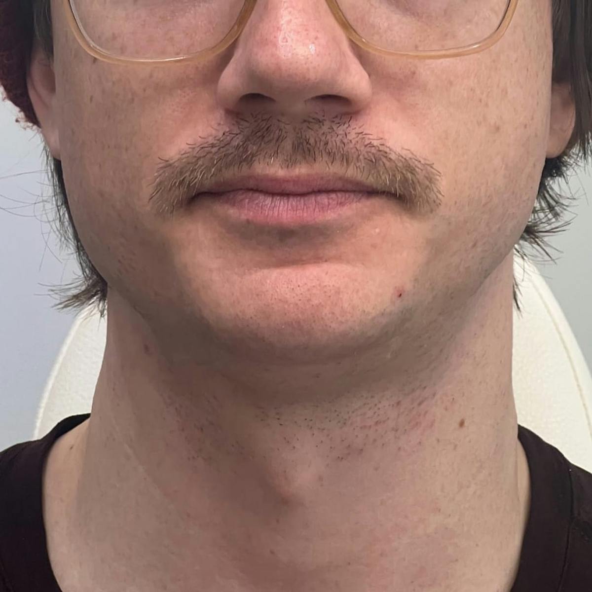 Before & Afters Before & After Gallery - Patient 130338 - Image 1