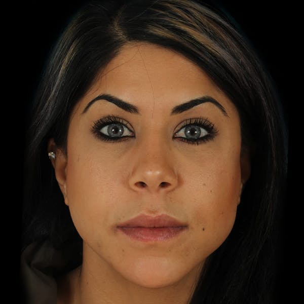 Before & Afters Before & After Gallery - Patient 351136 - Image 1