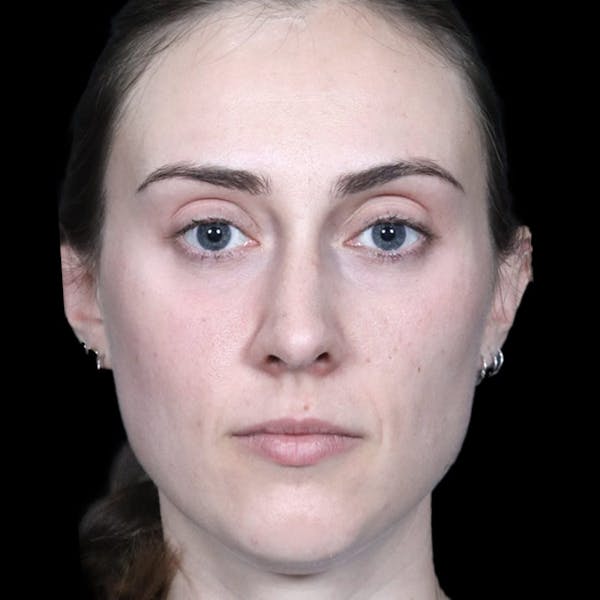 Before & Afters Before & After Gallery - Patient 121862 - Image 1