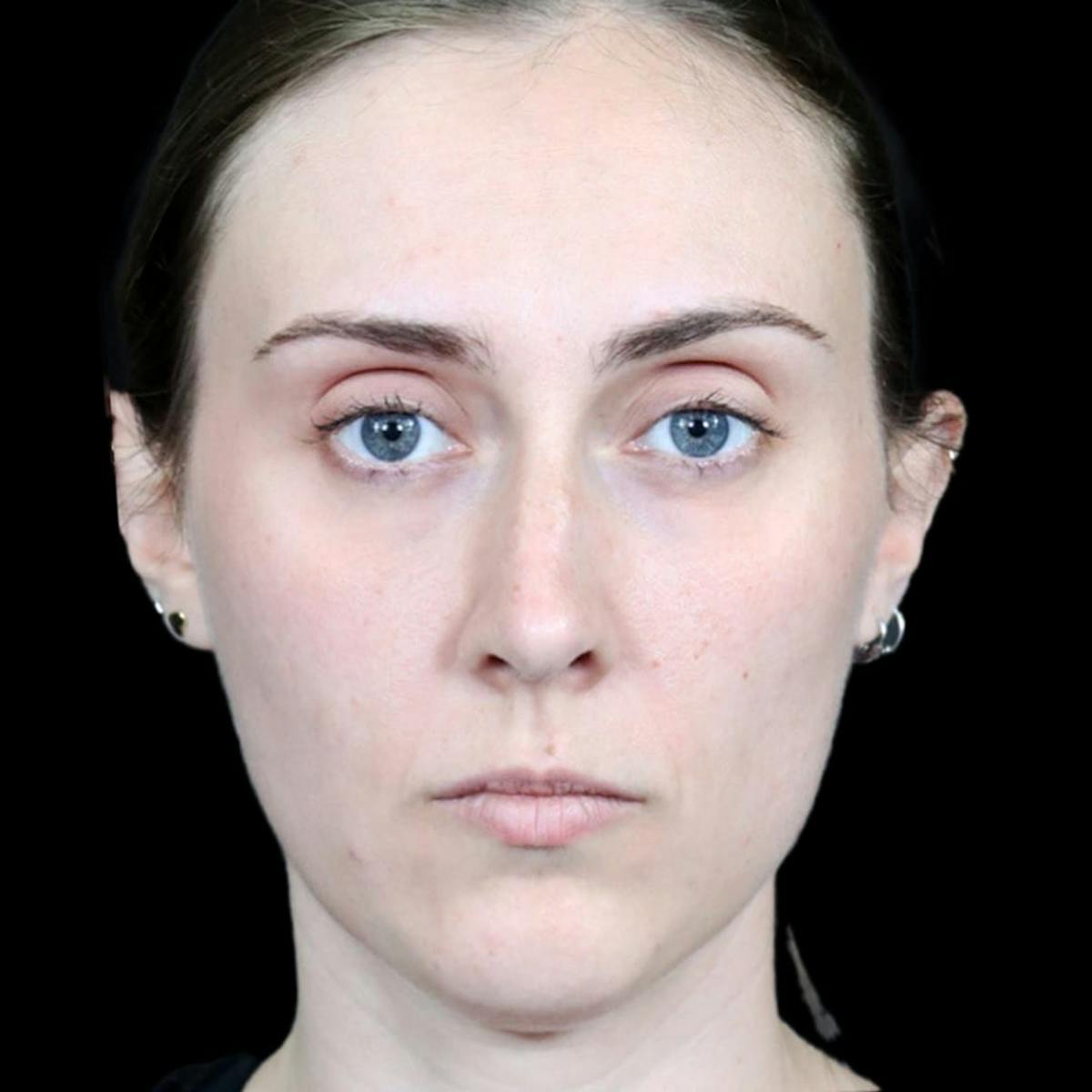 Before & Afters Before & After Gallery - Patient 121862 - Image 2