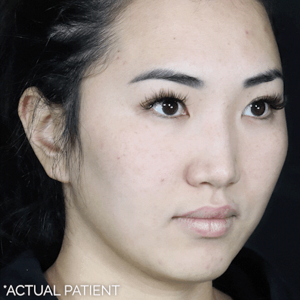 GIFs Before & After Gallery - Patient 667968 - Image 1
