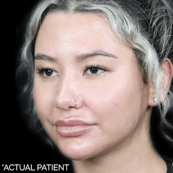 GIFs Before & After Gallery - Patient 336591 - Image 1