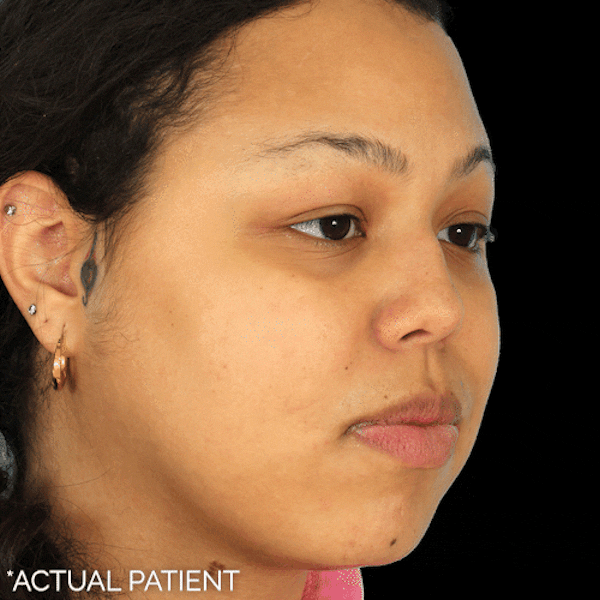 GIFs Before & After Gallery - Patient 581534 - Image 1