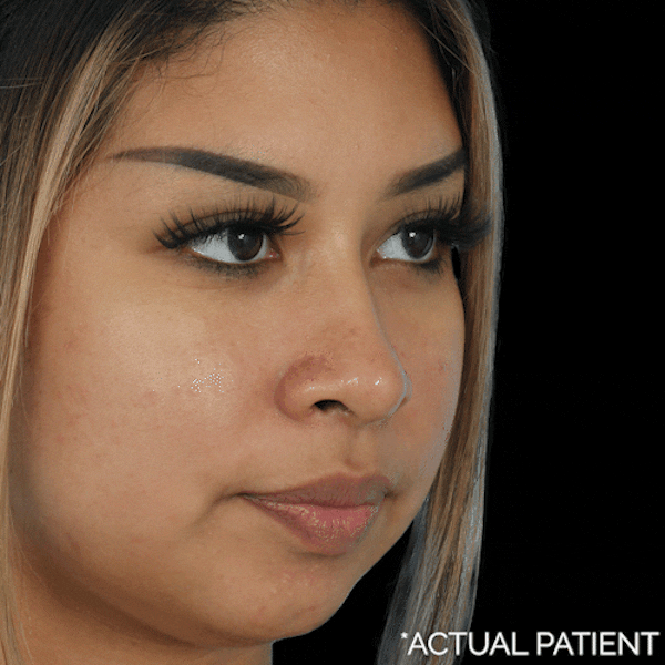 GIFs Before & After Gallery - Patient 175381 - Image 1