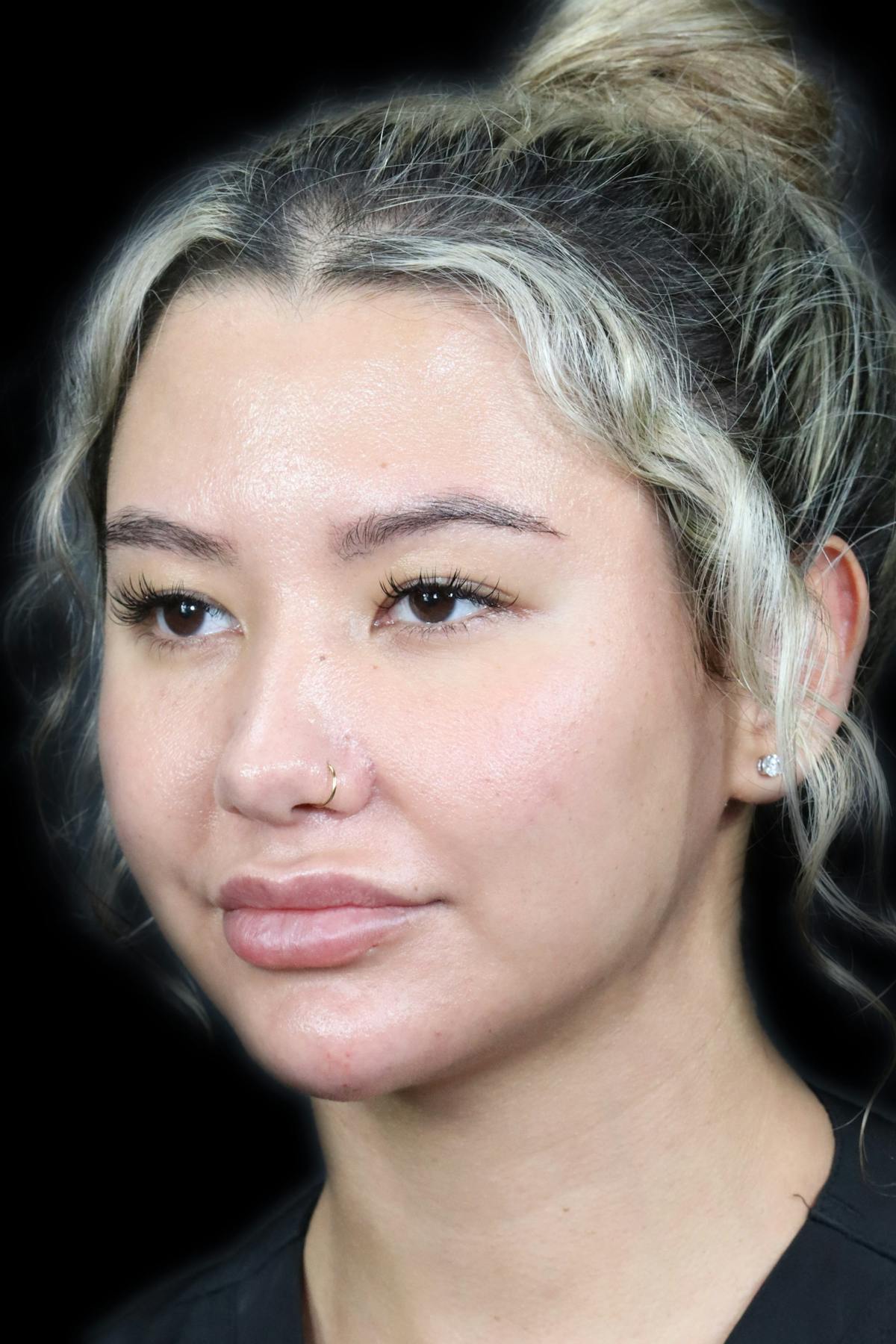 Before & Afters Before & After Gallery - Patient 141518 - Image 2