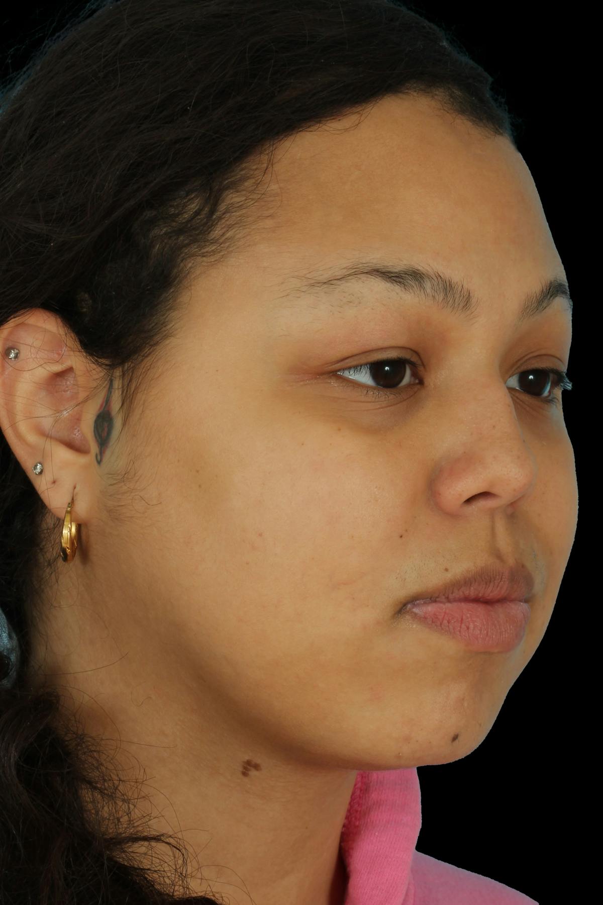 Before & Afters Before & After Gallery - Patient 293385 - Image 2