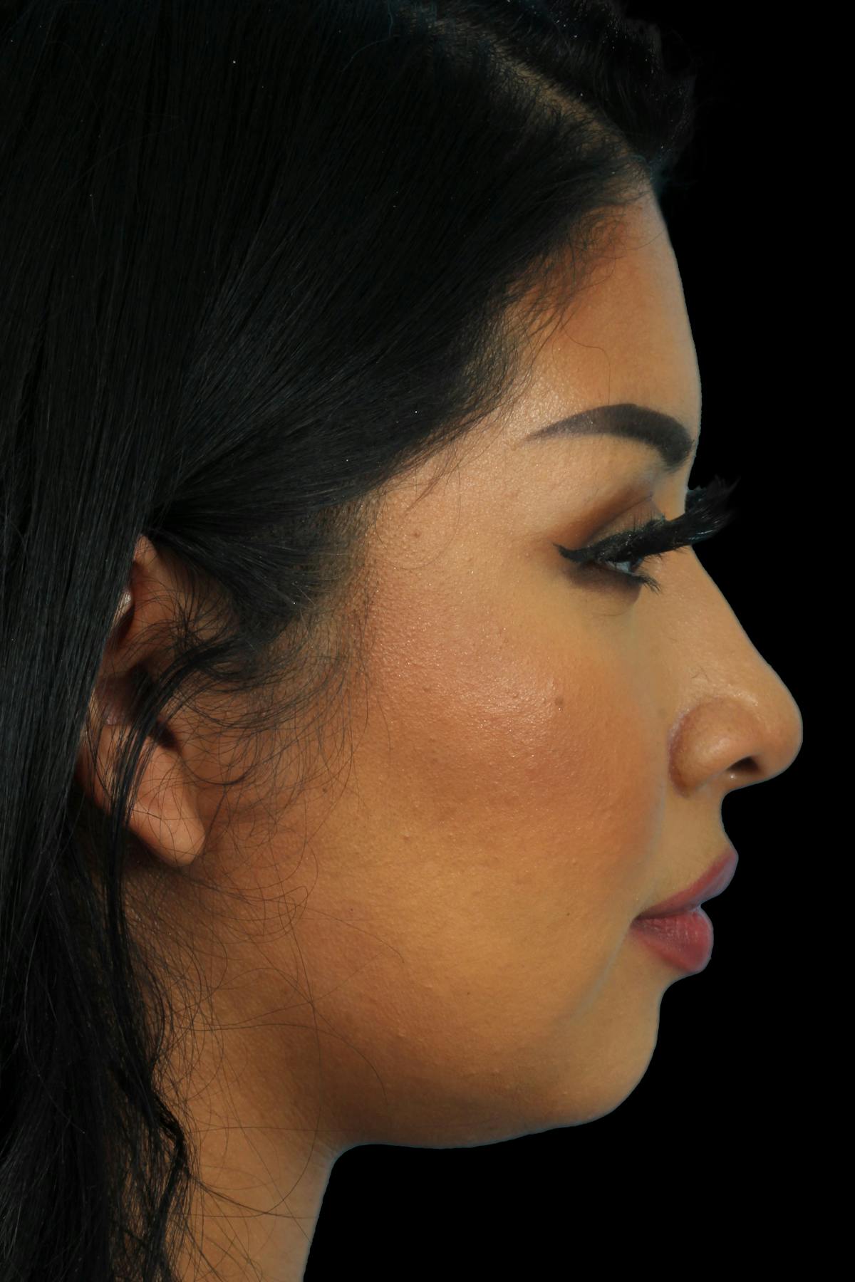 Before & Afters Before & After Gallery - Patient 247446 - Image 3