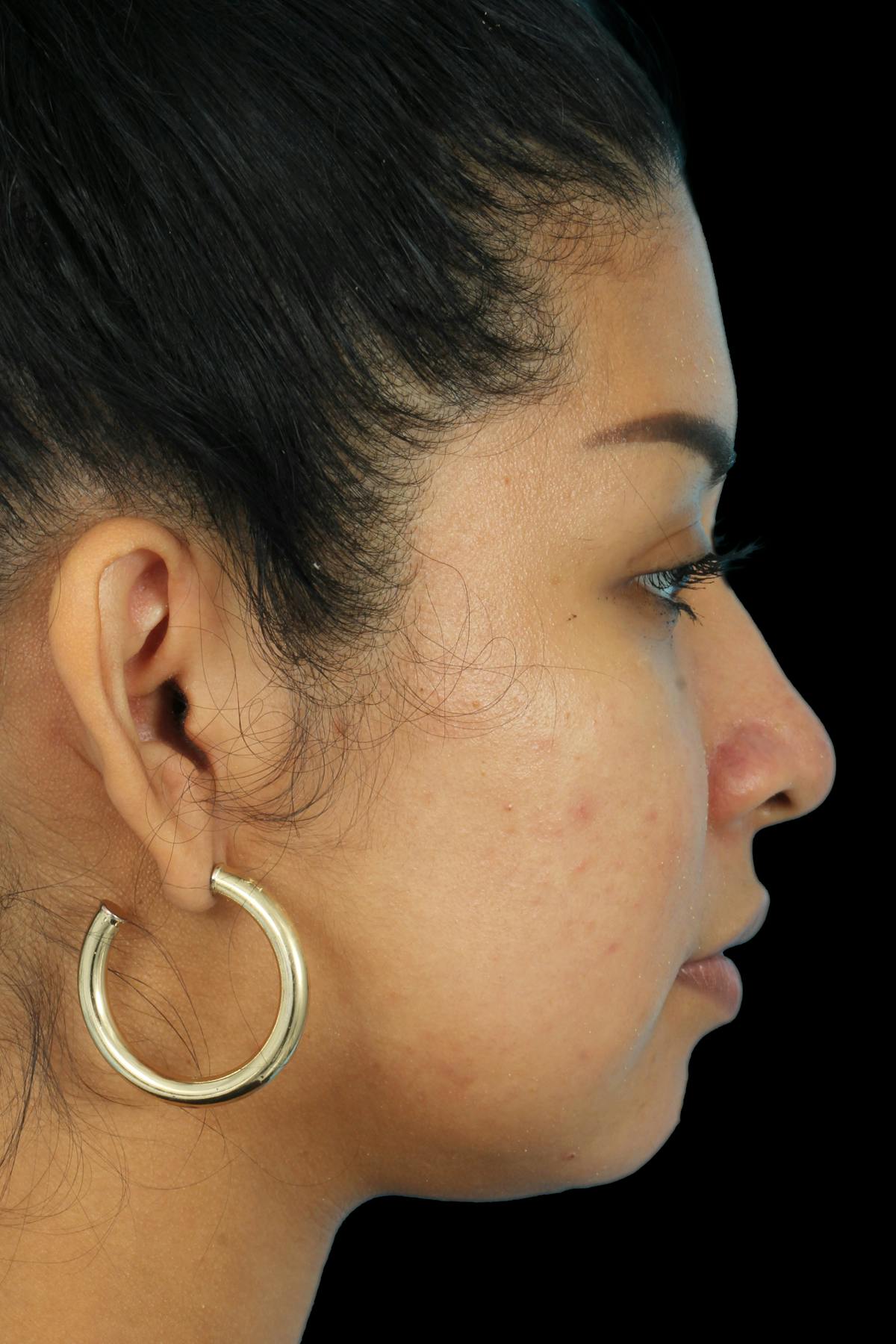 Before & Afters Before & After Gallery - Patient 247446 - Image 4