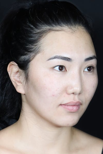 Before & Afters Before & After Gallery - Patient 333177 - Image 1