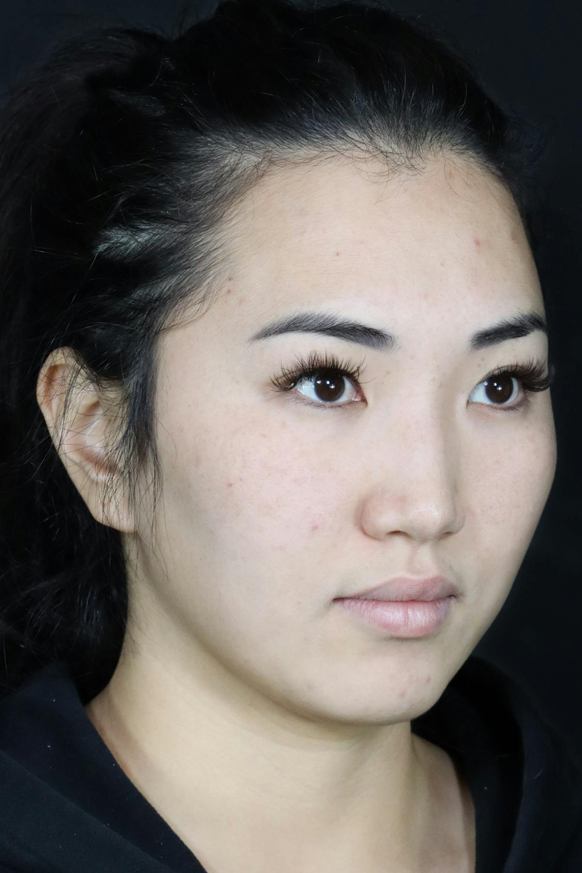 Before & Afters Before & After Gallery - Patient 333177 - Image 2