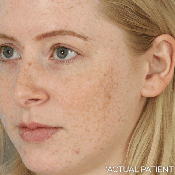 GIFs Before & After Gallery - Patient 129615 - Image 1