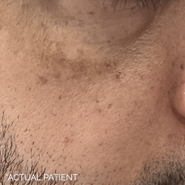 GIFs Before & After Gallery - Patient 185045 - Image 1