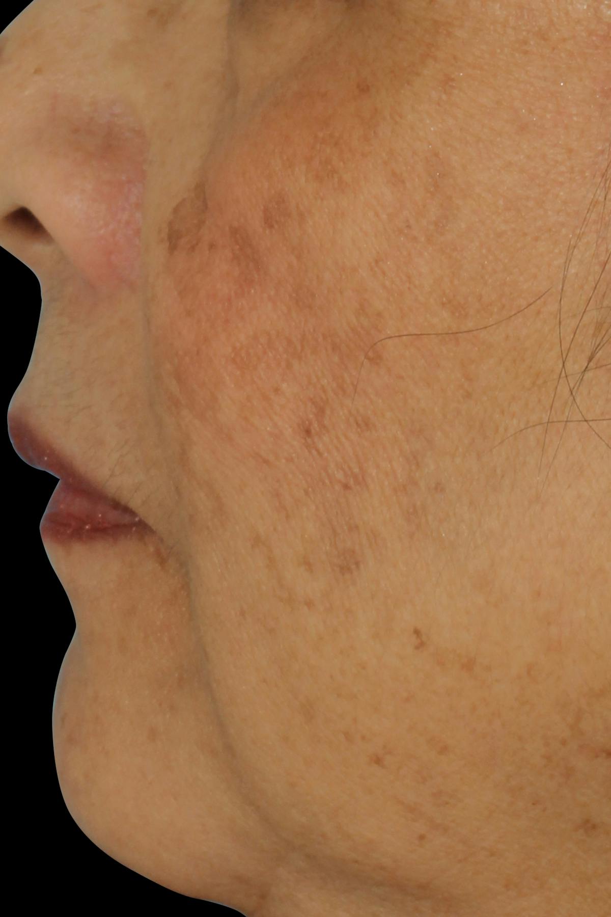 Before & Afters  Before & After Gallery - Patient 228398 - Image 2