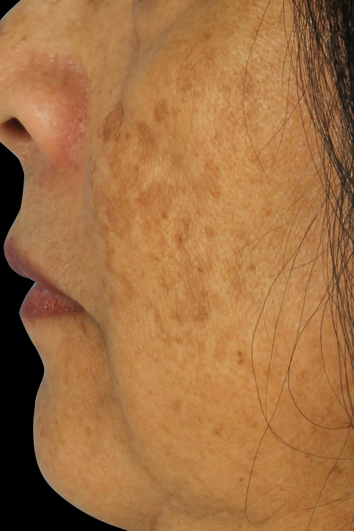 Before & Afters  Before & After Gallery - Patient 228398 - Image 1