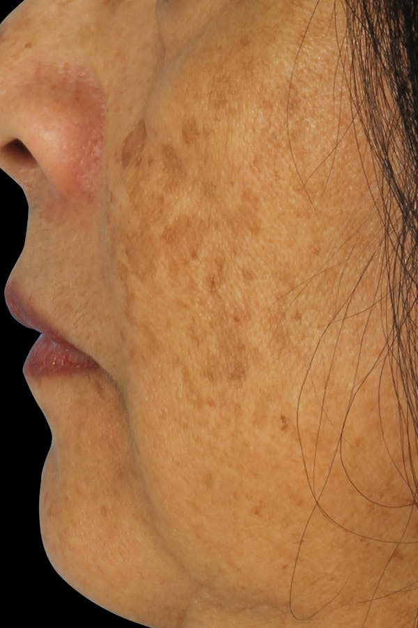Before & Afters  Before & After Gallery - Patient 228398 - Image 1