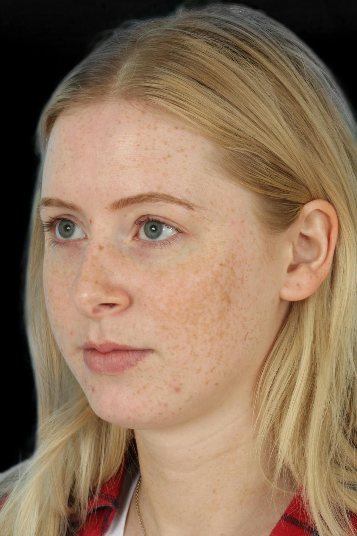 Before & Afters  Before & After Gallery - Patient 328850 - Image 1