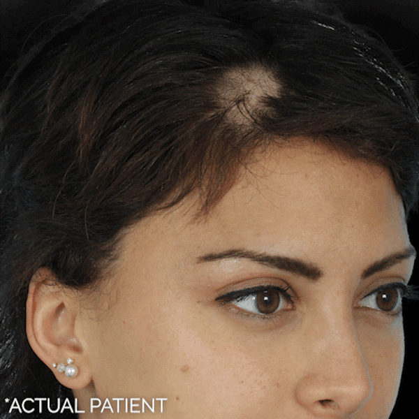 GIFs Before & After Gallery - Patient 274853 - Image 1