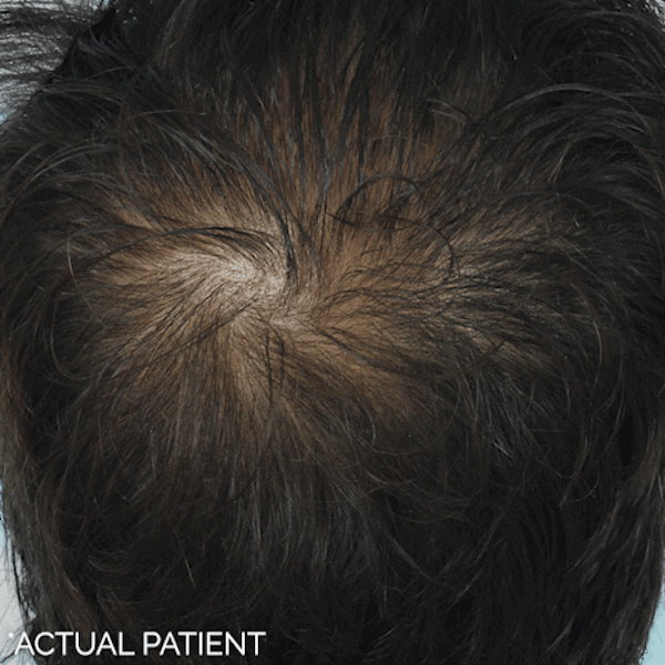GIFs Before & After Gallery - Patient 205968 - Image 1
