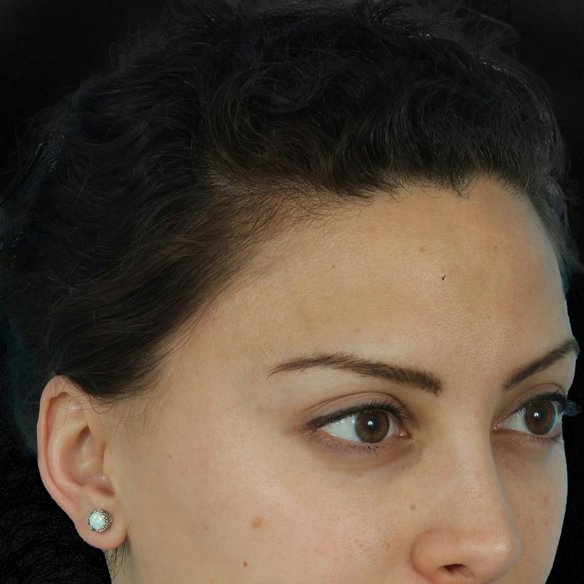 Before & Afters Before & After Gallery - Patient 428376 - Image 1