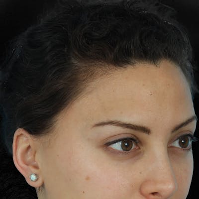 Before & Afters Before & After Gallery - Patient 428376 - Image 1