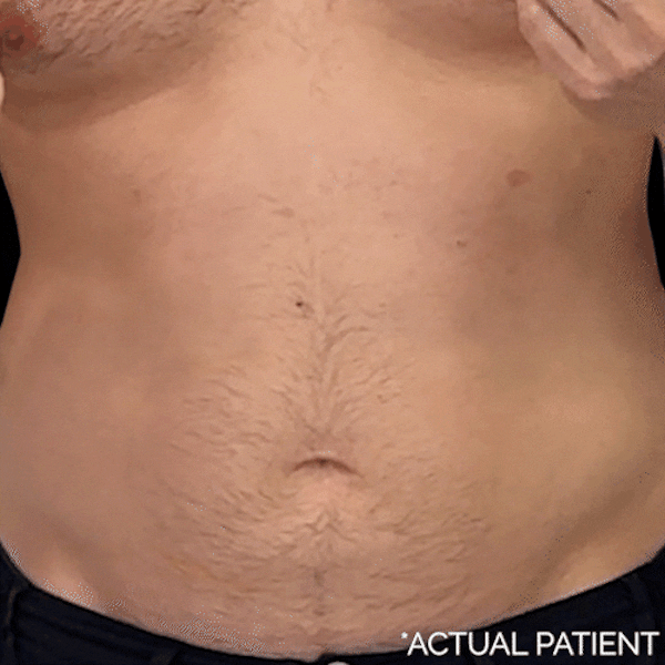 GIFs Before & After Gallery - Patient 233018 - Image 1