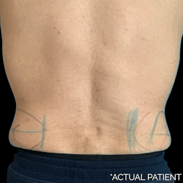 GIFs Before & After Gallery - Patient 164439 - Image 1