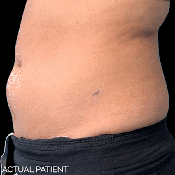 GIFs Before & After Gallery - Patient 386272 - Image 1
