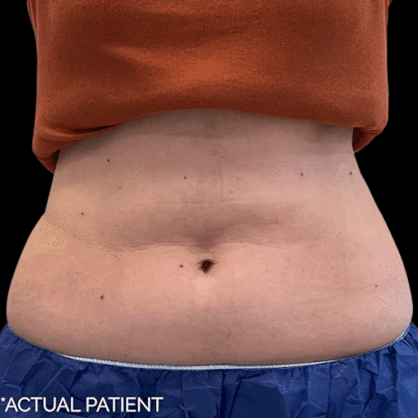 GIFs Before & After Gallery - Patient 378043 - Image 1