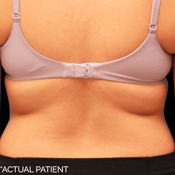 GIFs Before & After Gallery - Patient 290028 - Image 1